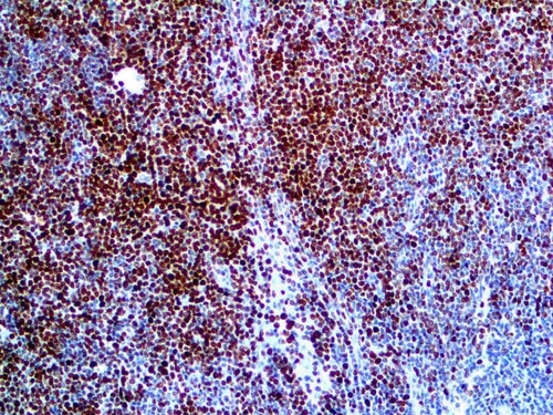 IHC of Histone H3 Phospho on an FFPE NH Lymphoma Tissue